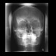 Fibrous dysplasia of frontal bone: X-ray - Plain radiograph